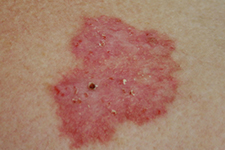 Intraepidermal Carcinoma