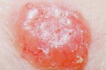 Basal Cell Carcinoma