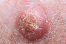 Squamous Cell Carcinoma