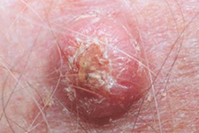 Squamous Cell Carcinoma